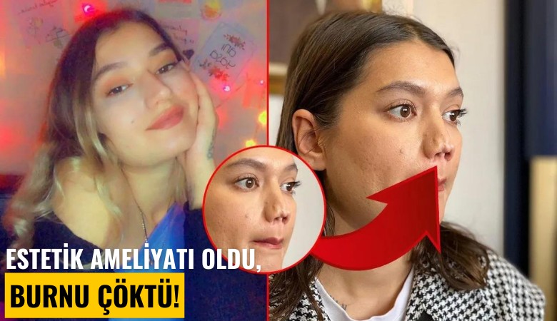 Estetik ameliyatı oldu, burnu çöktü!