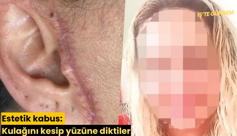 Estetik kabus: Kulağını kesip yüzüne diktiler