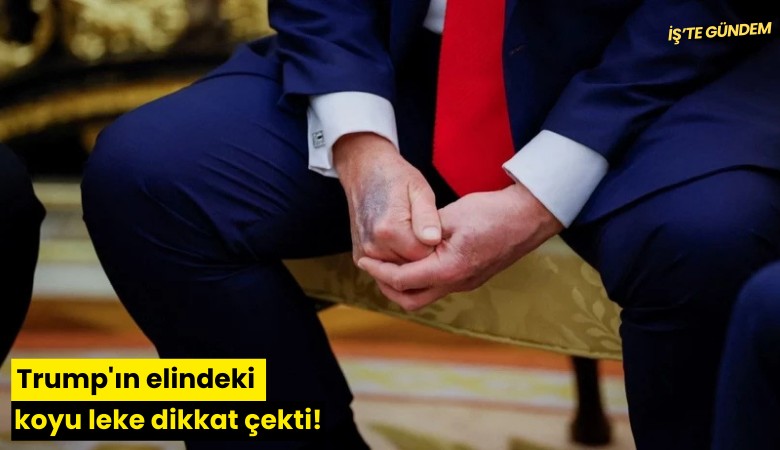 Trump'ın elindeki koyu leke dikkat çekti!
